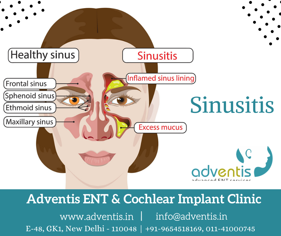 Rhinitis Treatment, Allergic Rhinitis Cure in Delhi | Adventis