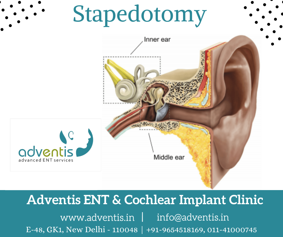 Stapedotomy Animation to Treat Otosclerosis (Curable Type of