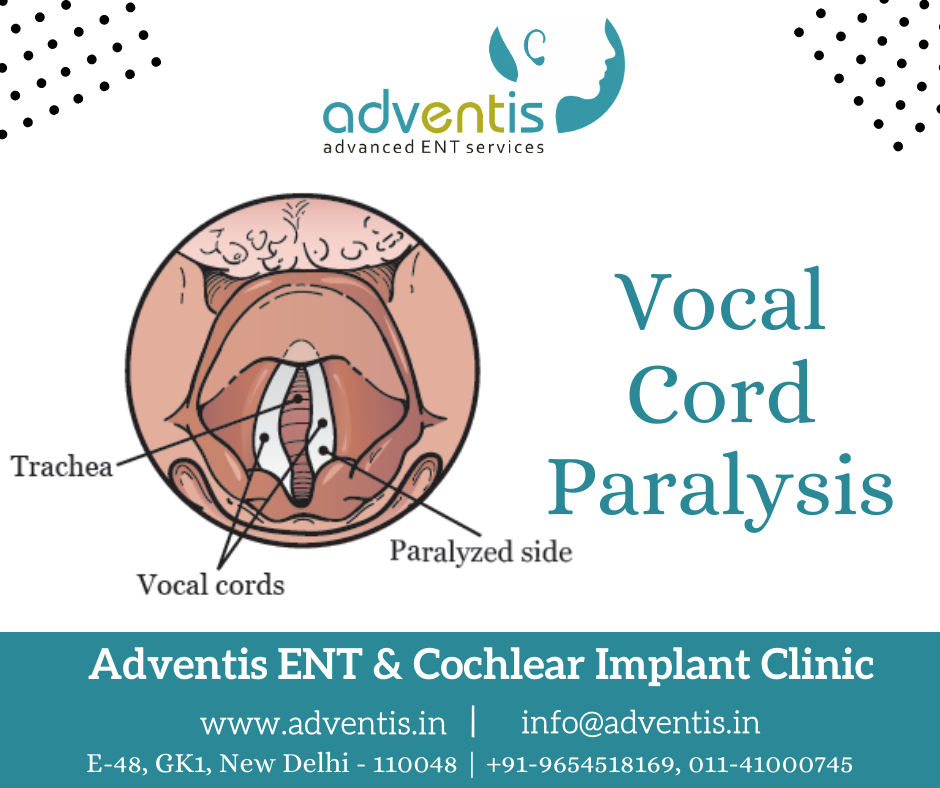 Can You Recover From Vocal Cord Paralysis