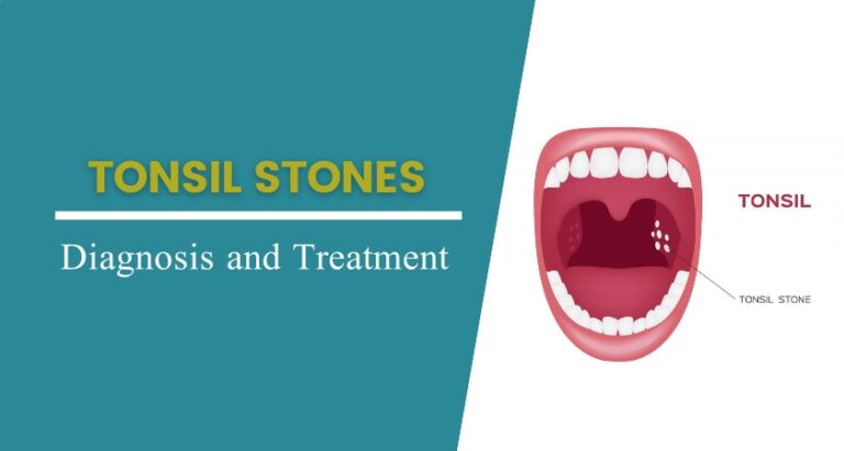 Tonsil Stones : Signs, Causes, Symptoms & Its Treatment | Adventis