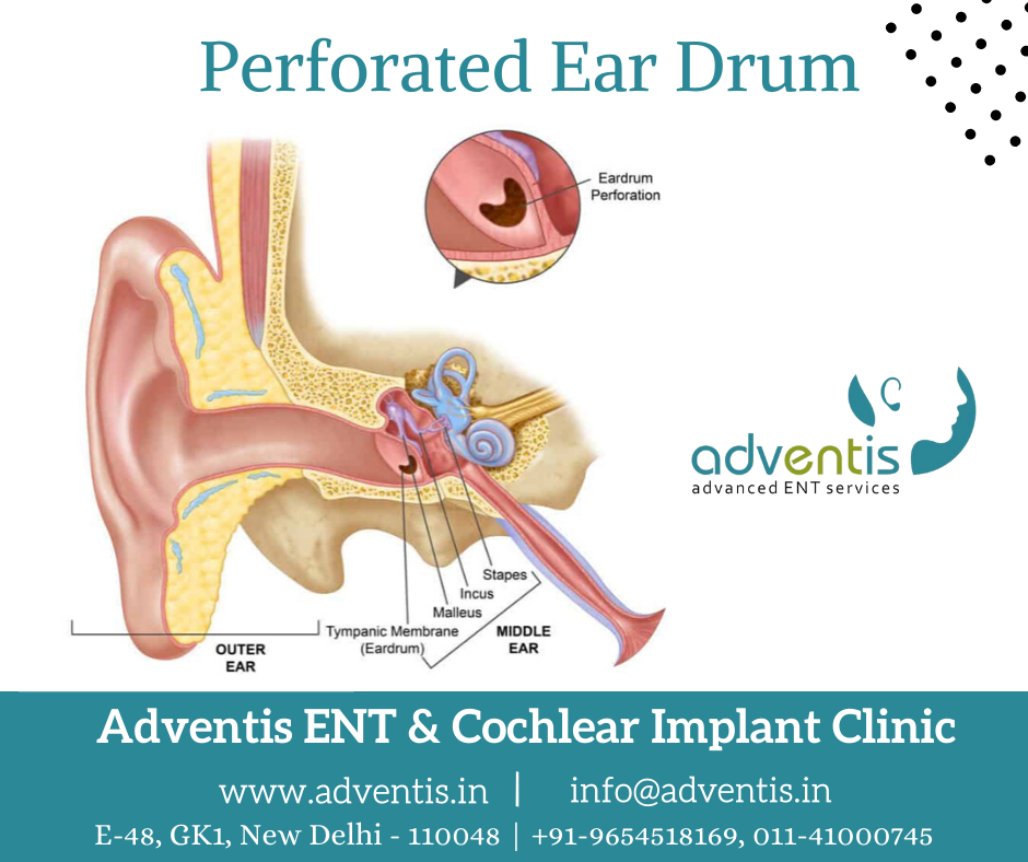 perforated-ear-drum-infection-treatment-in-delhi-india-adventis