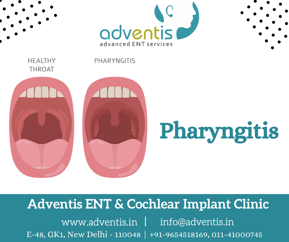 Pharyngitis - Throat (pharynx) Treatment in Delhi | Adventis